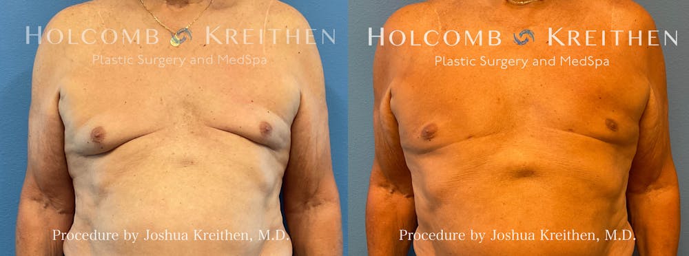 Gynecomastia Before & After Gallery - Patient 403278 - Image 1