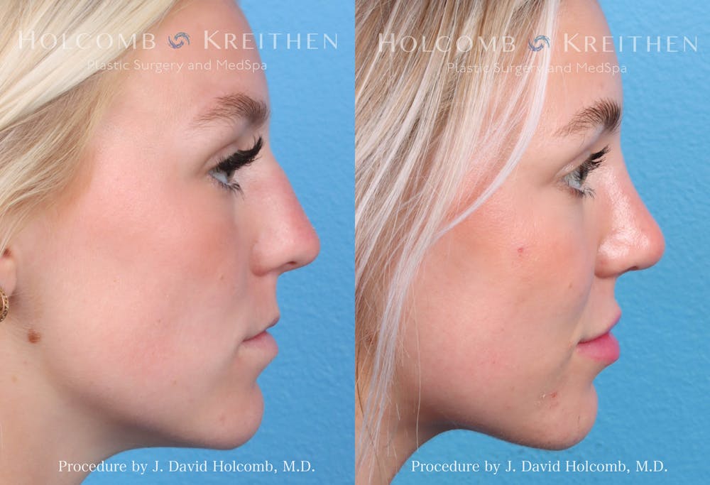 Rhinoplasty Before & After Gallery - Patient 211788 - Image 2