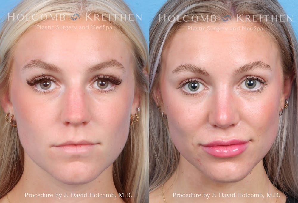 Rhinoplasty Before & After Gallery - Patient 211788 - Image 1
