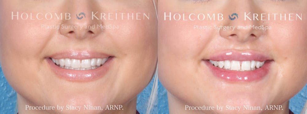 Fillers Before & After Gallery - Patient 206259 - Image 2
