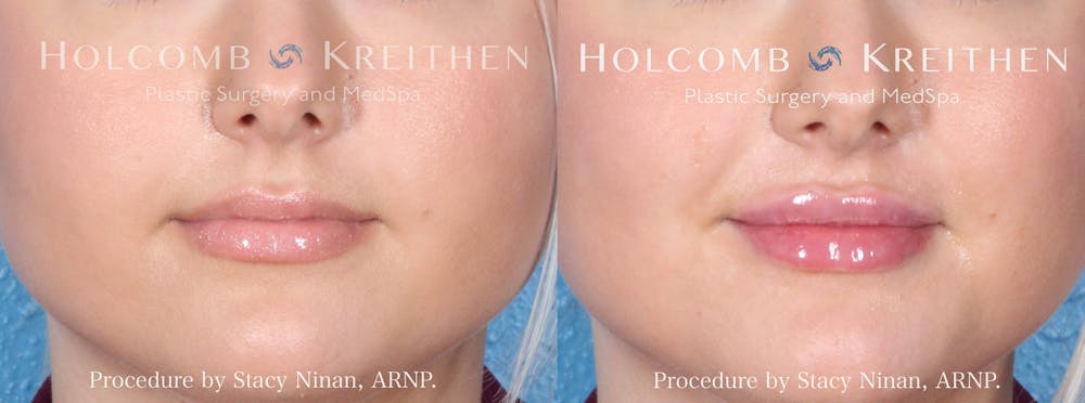 Fillers Before & After Gallery - Patient 206259 - Image 1