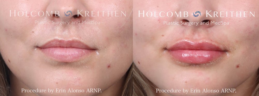Fillers Before & After Gallery - Patient 203972 - Image 1