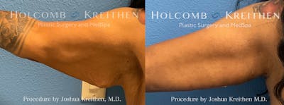 Arm Lift Before & After Gallery - Patient 237904 - Image 1
