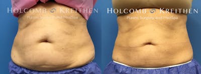 Coolsculpting Before & After Gallery - Patient 399103 - Image 1