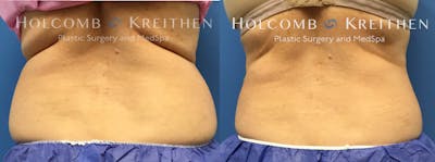 Coolsculpting Before & After Gallery - Patient 399103 - Image 2