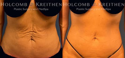 Tummy Tuck Before & After Gallery - Patient 371612 - Image 1
