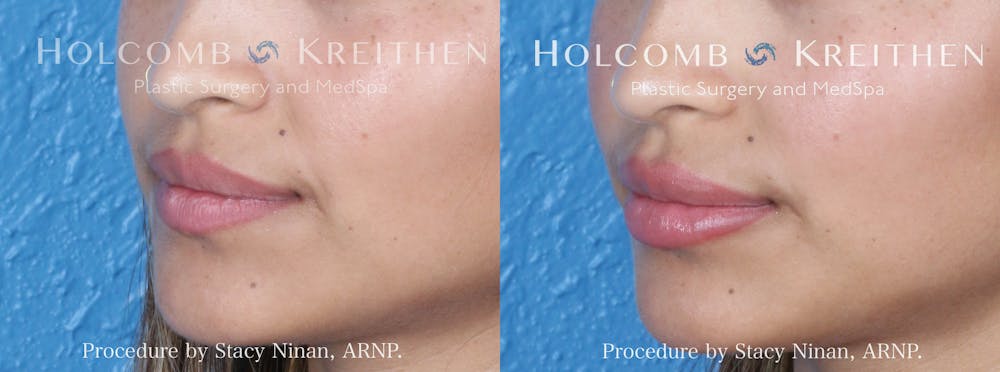 Fillers Before & After Gallery - Patient 853628 - Image 3