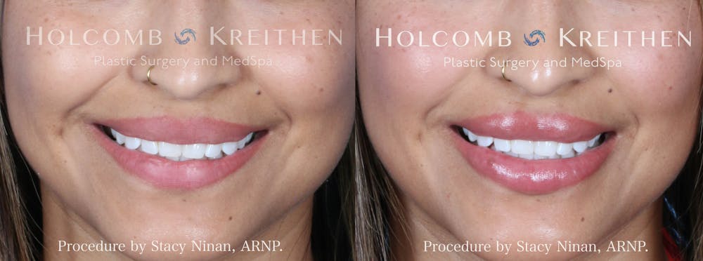 Fillers Before & After Gallery - Patient 853628 - Image 2
