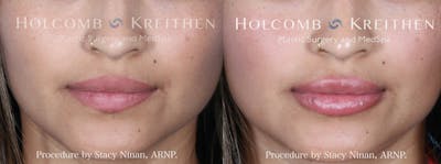Fillers Before & After Gallery - Patient 853628 - Image 1