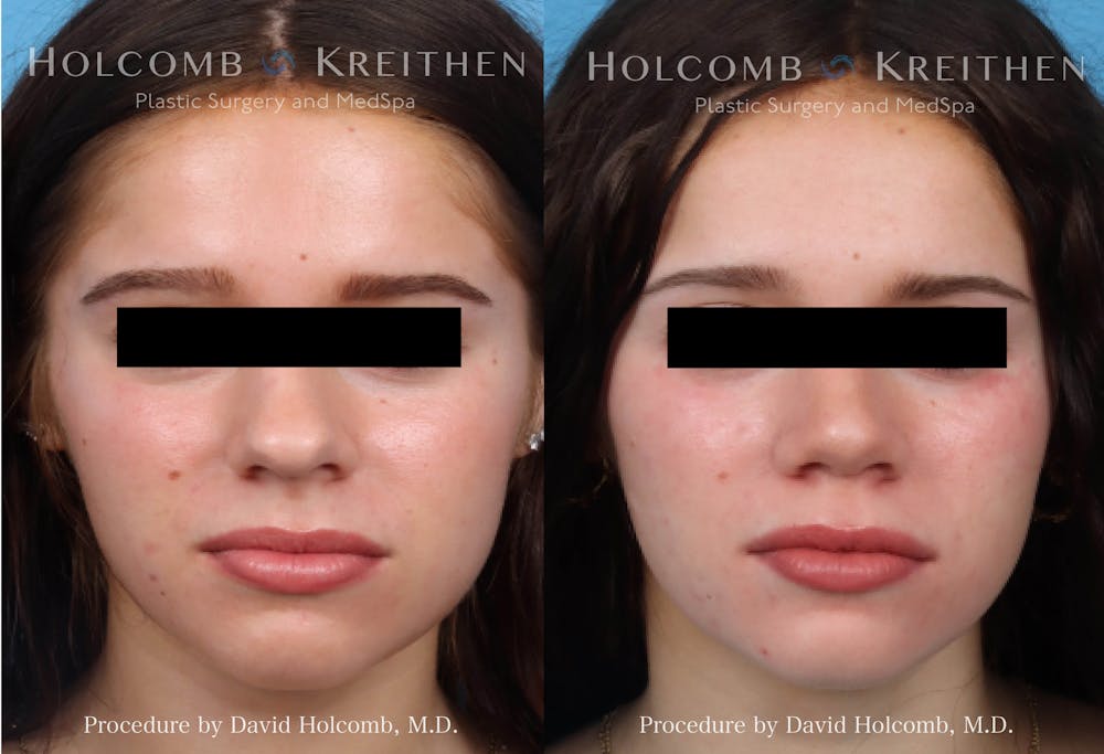 Rhinoplasty Before & After Gallery - Patient 223747 - Image 1