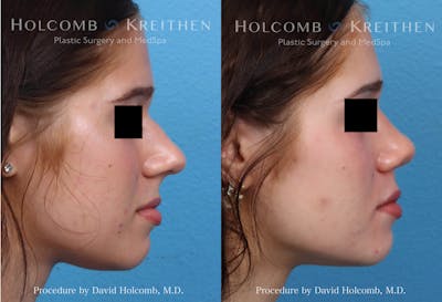 Rhinoplasty Before & After Gallery - Patient 223747 - Image 2