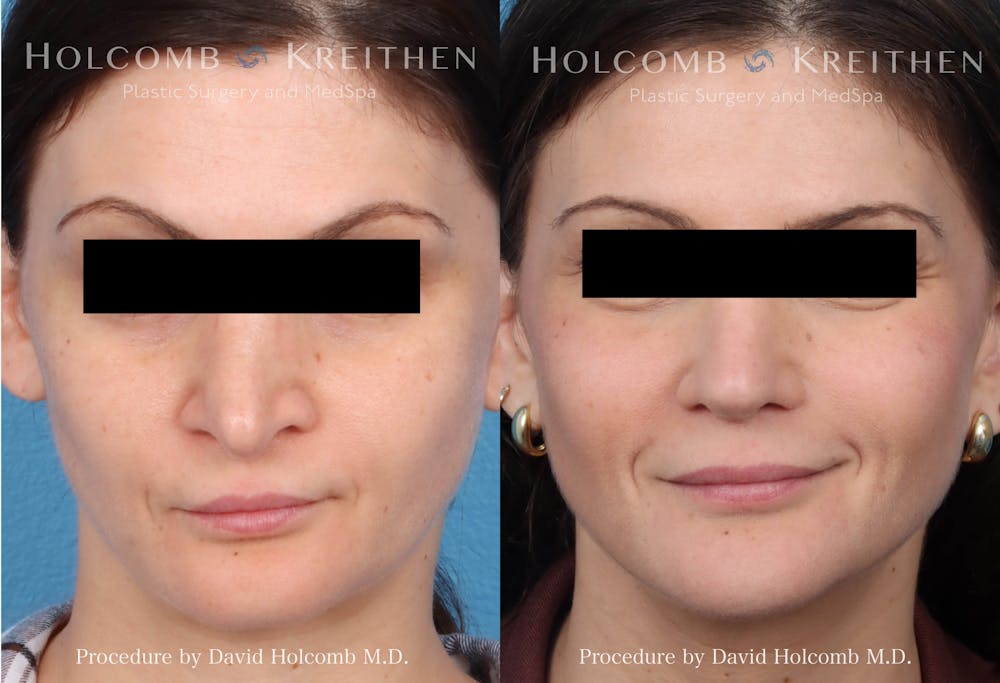 Rhinoplasty Before & After Gallery - Patient 864591 - Image 1