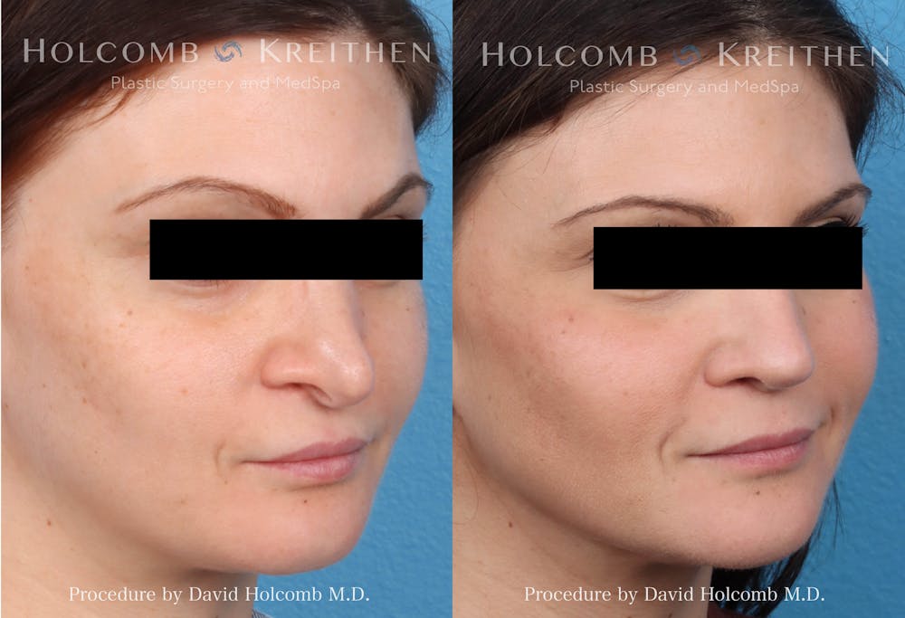 Rhinoplasty Before & After Gallery - Patient 864591 - Image 2