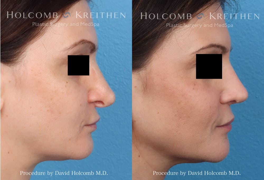 Rhinoplasty Before & After Gallery - Patient 864591 - Image 3