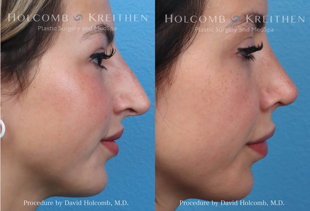 Rhinoplasty Before & After Gallery - Patient 319720 - Image 2