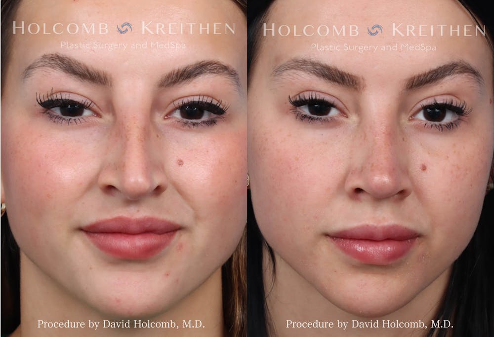 Rhinoplasty Before & After Gallery - Patient 319720 - Image 1