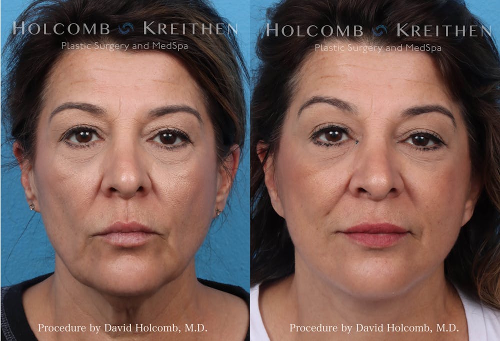 Energy Assisted Face/Neck Lift Before & After Gallery - Patient 290425 - Image 1