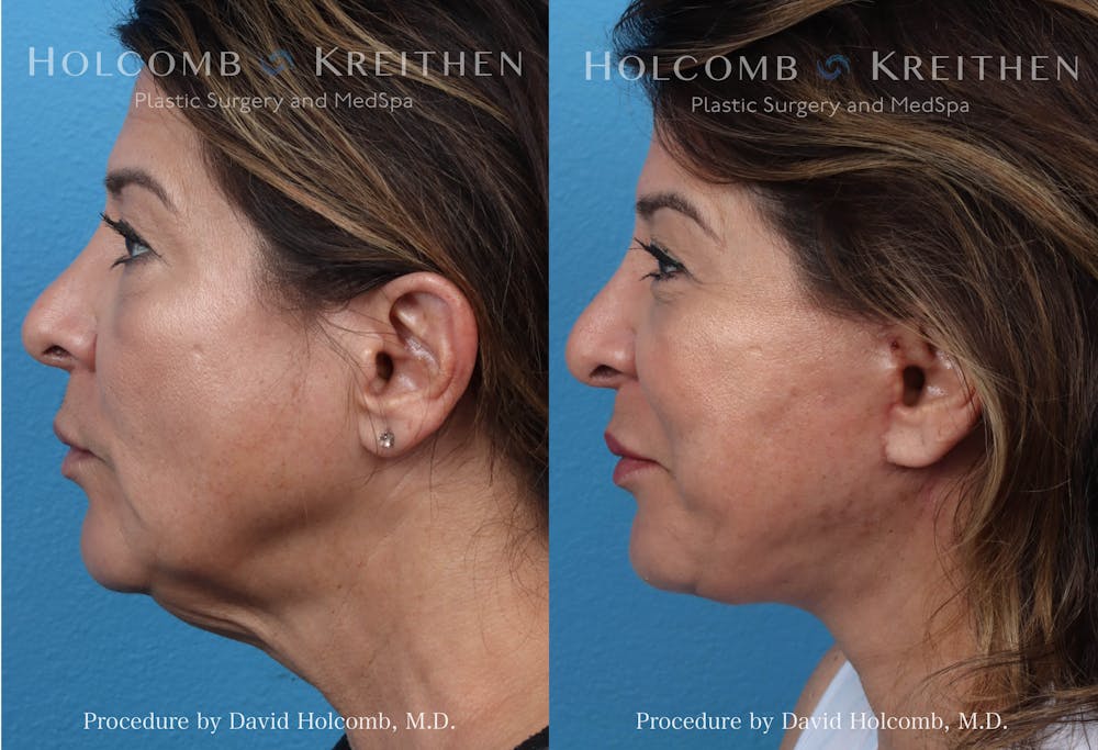 Energy Assisted Face/Neck Lift Before & After Gallery - Patient 290425 - Image 3