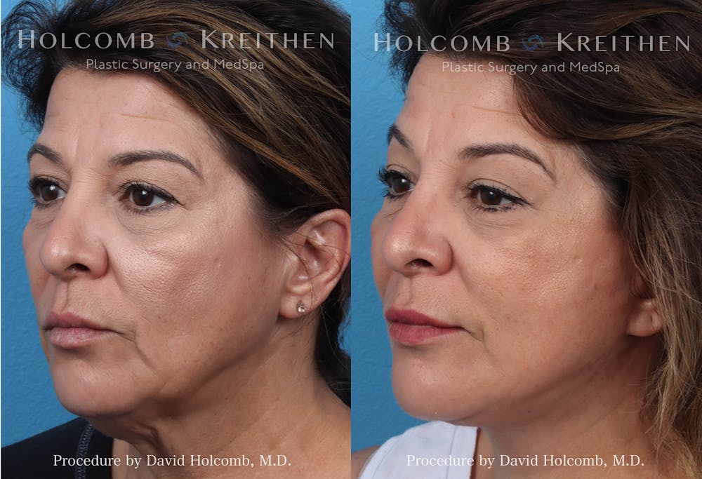 Energy Assisted Face/Neck Lift Before & After Gallery - Patient 290425 - Image 2