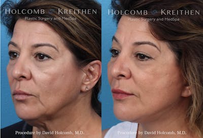 Energy Assisted Face/Neck Lift Before & After Gallery - Patient 290425 - Image 2
