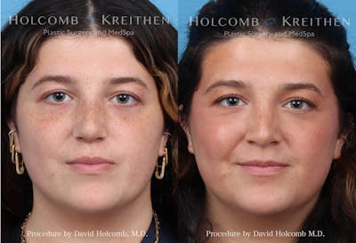 Rhinoplasty Before & After Gallery - Patient 348689 - Image 1