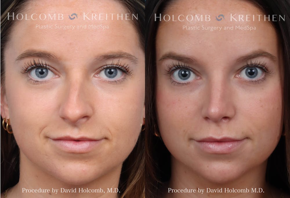 Rhinoplasty Before & After Gallery - Patient 622626 - Image 1