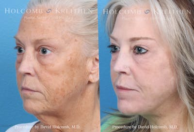 eCO2 Fractional Laser Before & After Gallery - Patient 379732 - Image 2