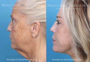 Facelift