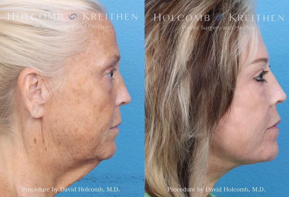 eCO2 Fractional Laser Before & After Gallery - Patient 379732 - Image 4