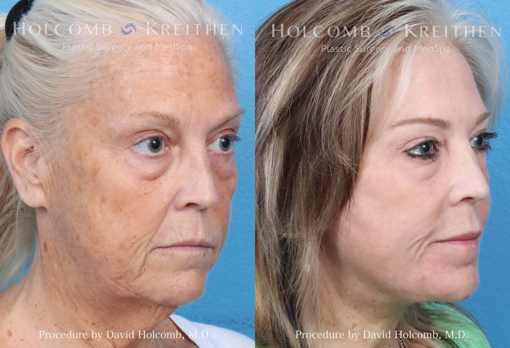 eCO2 Fractional Laser Before & After Gallery - Patient 379732 - Image 5