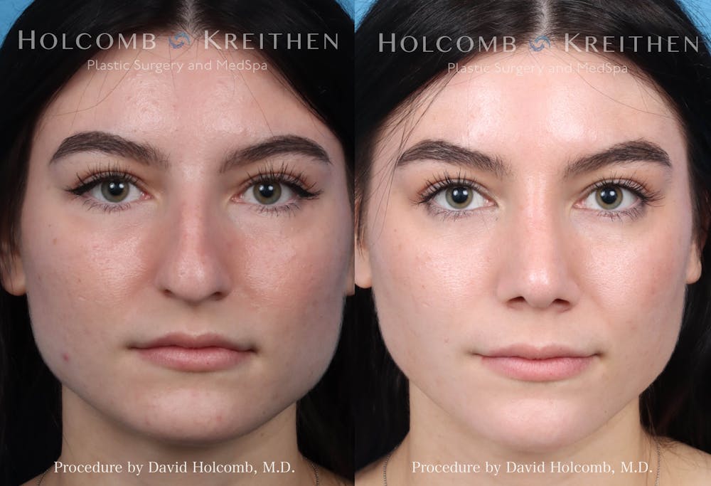 Rhinoplasty Before & After Gallery - Patient 228626 - Image 1