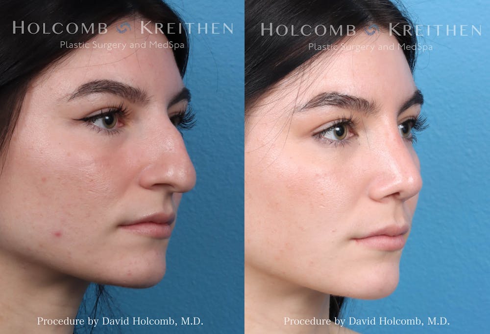 Rhinoplasty