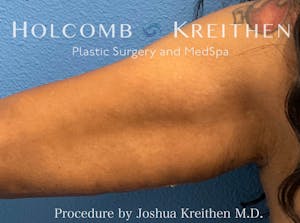 arm lift procedure