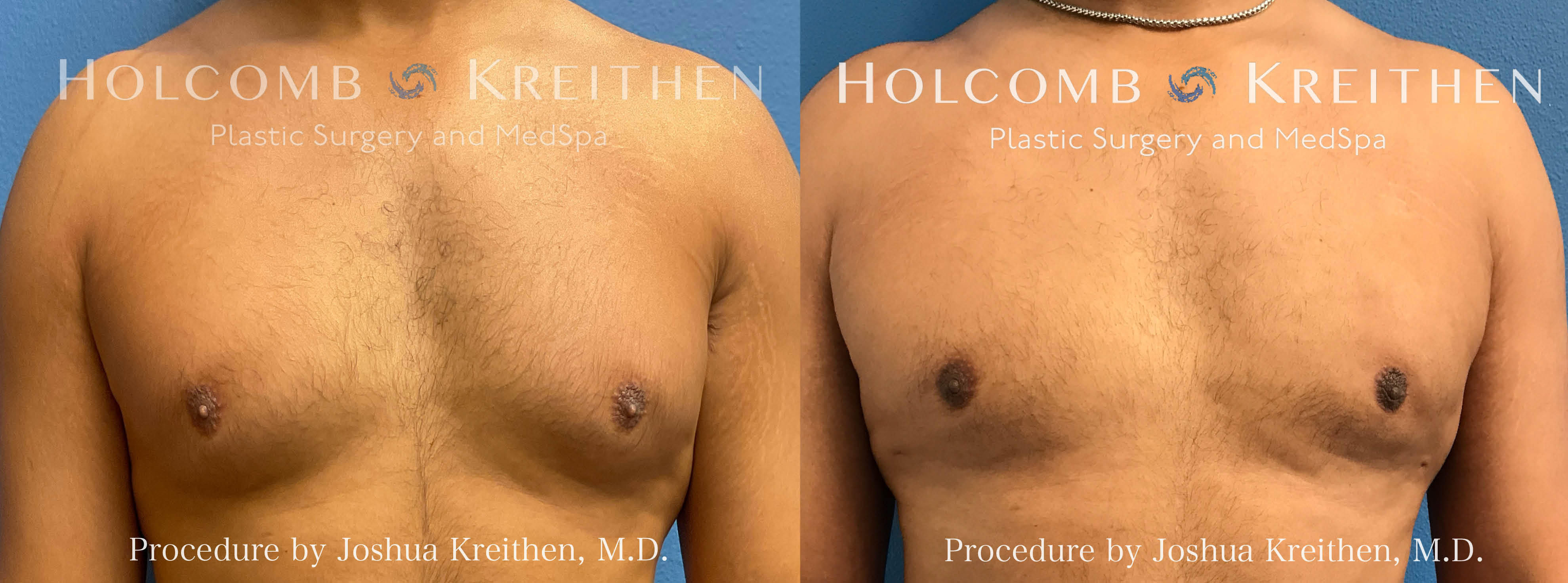 gynecomastia 1