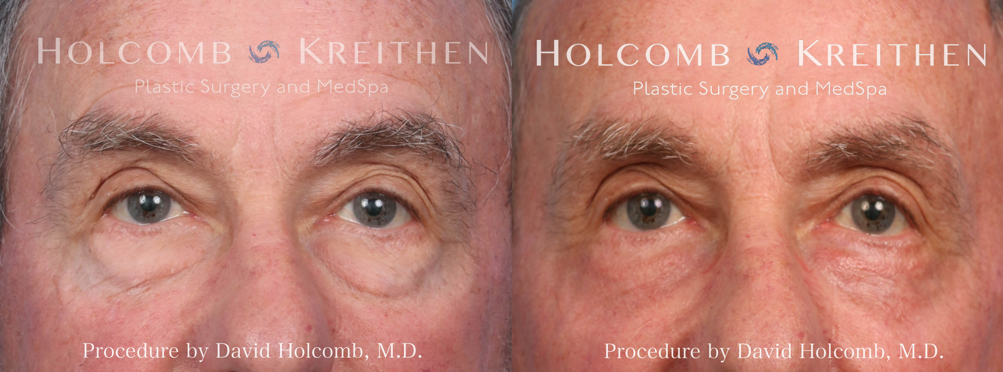 mens eyelid lift