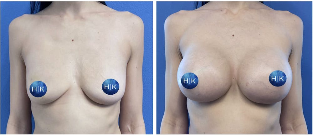 Breast Augmentation Before & After Gallery - Patient 239151 - Image 1