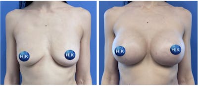 Breast Augmentation Before & After Gallery - Patient 239151 - Image 1