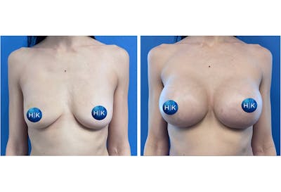 Breast Augmentation Before & After Gallery - Patient 239151 - Image 1