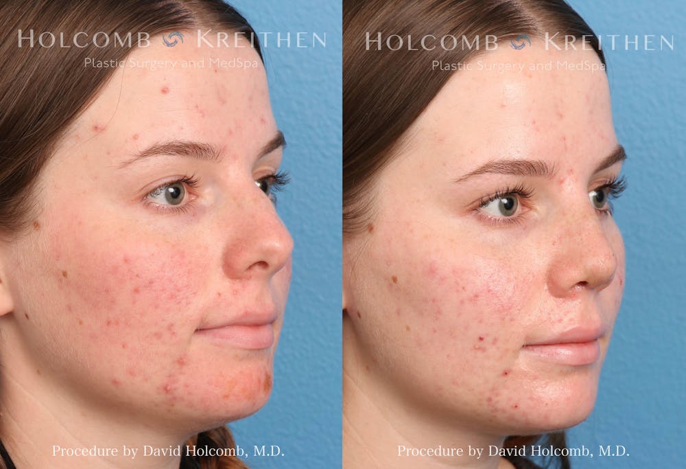 Rhinoplasty Before & After Gallery - Patient 235599 - Image 2