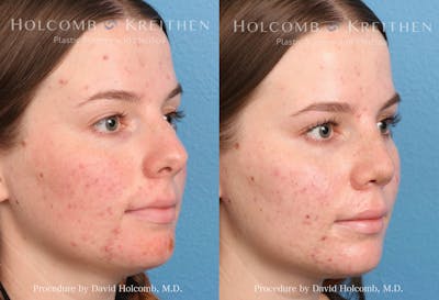 Rhinoplasty Before & After Gallery - Patient 235599 - Image 2
