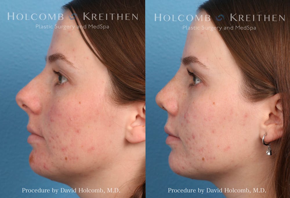 Rhinoplasty Before & After Gallery - Patient 235599 - Image 5