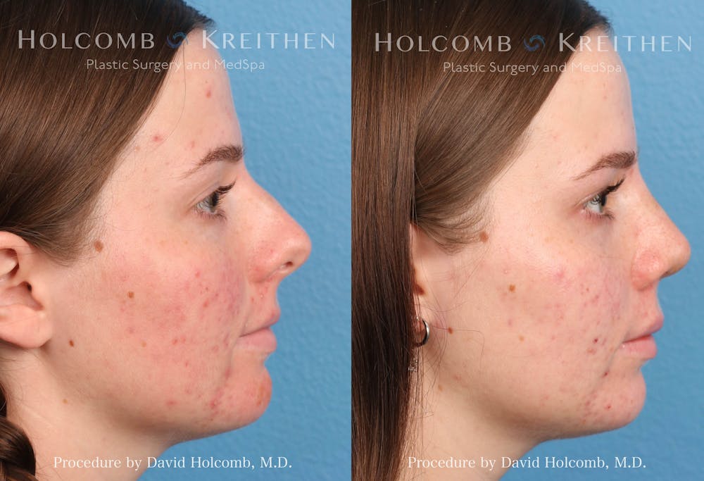 Rhinoplasty Before & After Gallery - Patient 235599 - Image 3