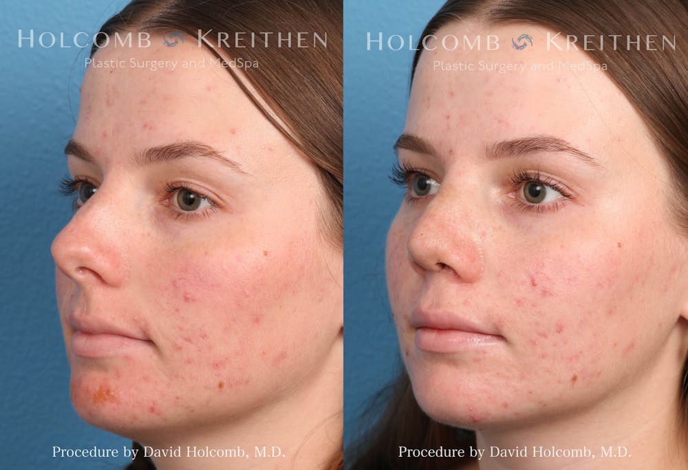 Rhinoplasty Before & After Gallery - Patient 235599 - Image 4