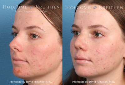 Rhinoplasty Before & After Gallery - Patient 235599 - Image 4