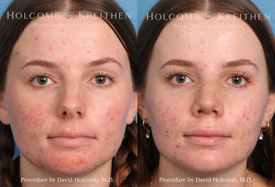 Rhinoplasty Before & After Gallery - Patient 235599 - Image 1