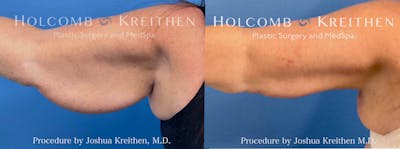 Arm Lift Before & After Gallery - Patient 329522 - Image 1