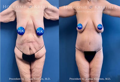 Lower Body Lift Before & After Gallery - Patient 301820 - Image 1
