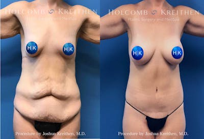 Lower Body Lift Before & After Gallery - Patient 356801 - Image 1