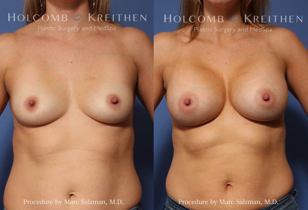 Breast Augmentation Before & After Gallery - Patient 591632 - Image 1