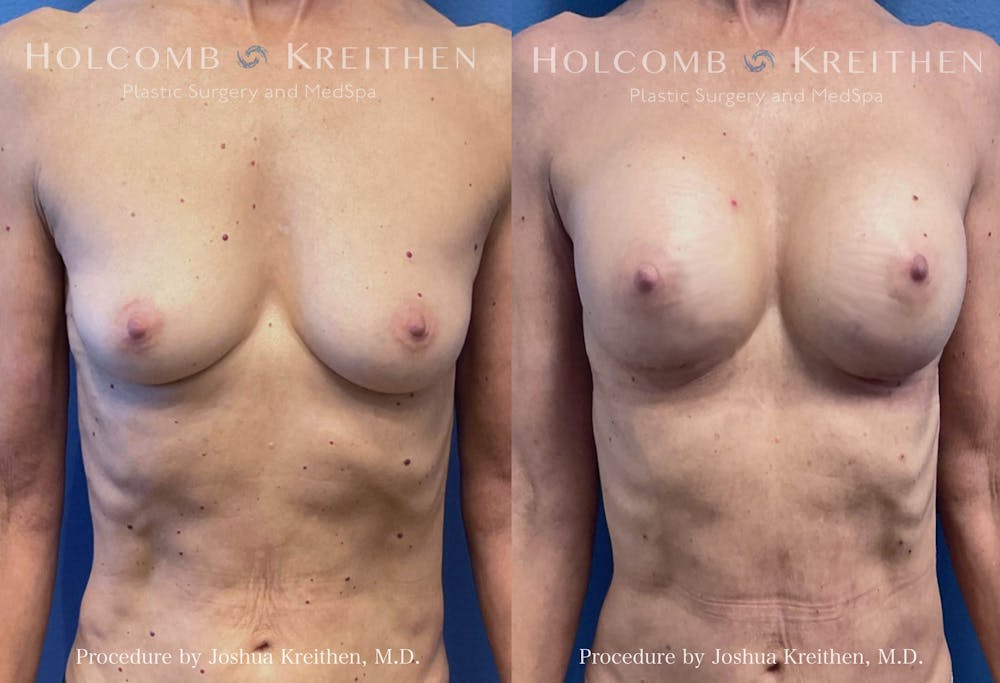 Breast Augmentation Before & After Gallery - Patient 368495 - Image 1